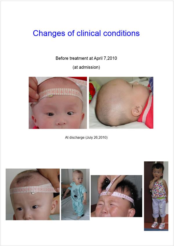 儿童脑积水的治疗